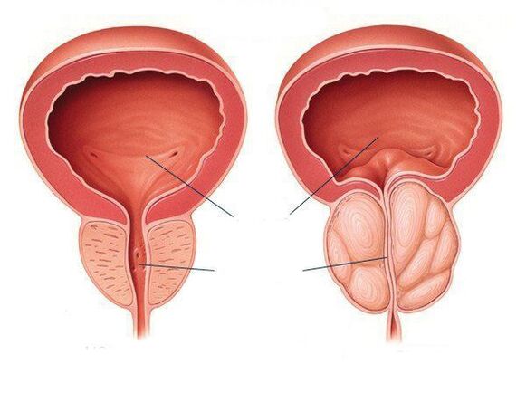 normal prostate and prostate inflammation