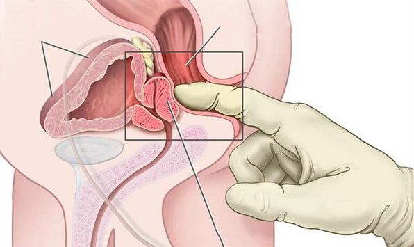 rectal examination of the prostate